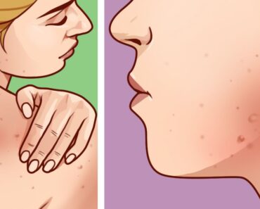 If you have body acne, here’s what it means about your health