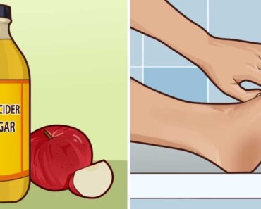 Natural ways to quickly heal a blister