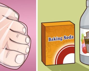 Get rid of embarrassing nail fungus by trying one of these 6+ natural remedies